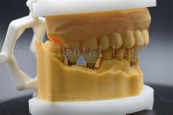 Corona dentale in titanio di precisione per impianto dentale facile da pulire e mantenere