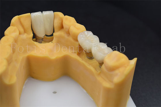 Restituzione dentale personalizzabile Impianto sostituzione corona varie dimensioni