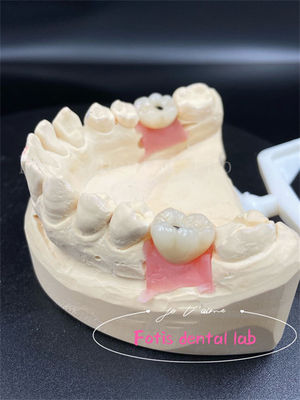 Personalizzazione Corona di laboratorio dentale in titanio/siconia/PFM