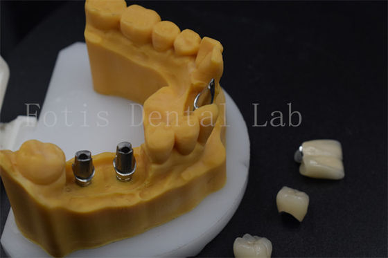 Corona di impianto dentale di alta durata facile da regolare Guida degli impianti dentali maniche