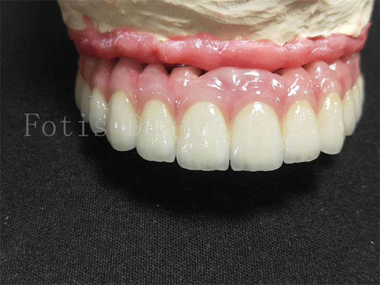 Corona di impianto in titanio / zirconia lucidata finitura corona dentale artificiale