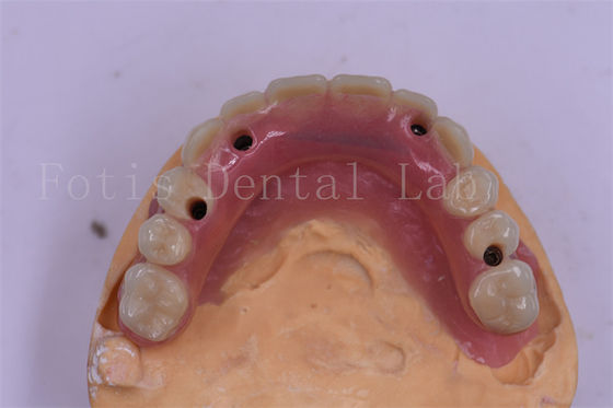 Impianto dentale in titanio corona dentale di precisione adatta Disegno personalizzato