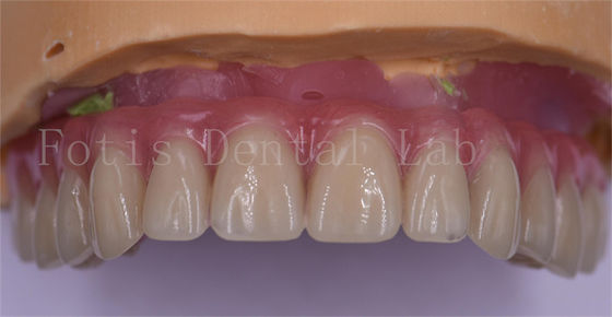 Comfort del paziente Coroane dentali personalizzate in titanio/zirconia/PFM