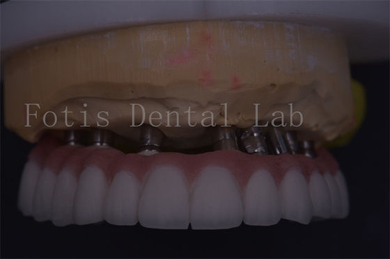 Precisione della corona dentale d'argento personalizzabile adatta per un rifacimento comodo