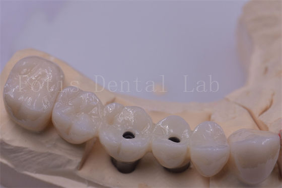 Corona dentale in titanio / zirconia argento lucidato per denti mancanti