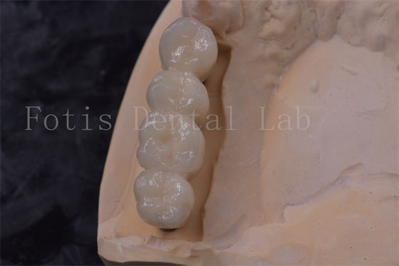 Precision Fit Implantazione corona dentale di zirconia corona PFM facile da pulire