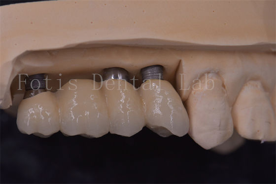 Corone per impianti dentali di precisione Titanio / Zirconia / PFM Restauro dei denti mancanti