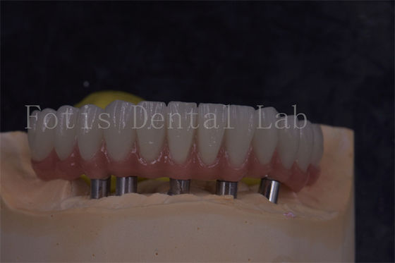 Coroane personalizzabili per impianti dentali per un aspetto naturale e rifacimenti confortevoli