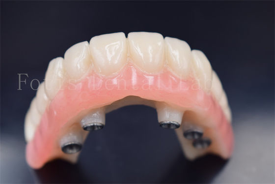 Impianti dentali personalizzati Corone sostitutive resistenza all'usura