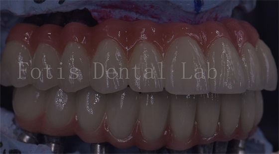 Servizio OEM Impianto dentale durevole Corona temporanea Facile manutenzione
