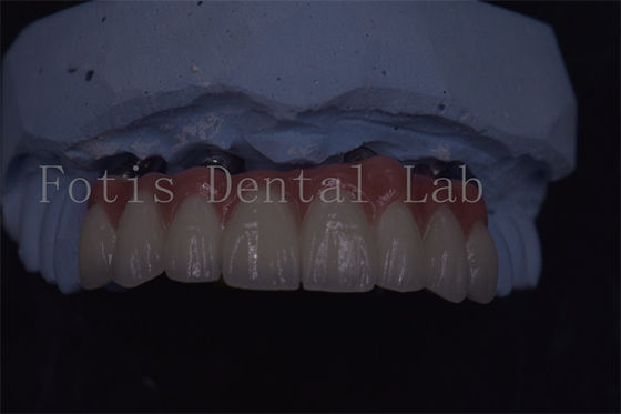 Corone per impianti dentali di precisione per una longevità e un comfort superiori
