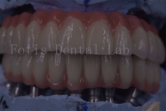 Corone di impianto dentale avanzate per una funzionalità superiore