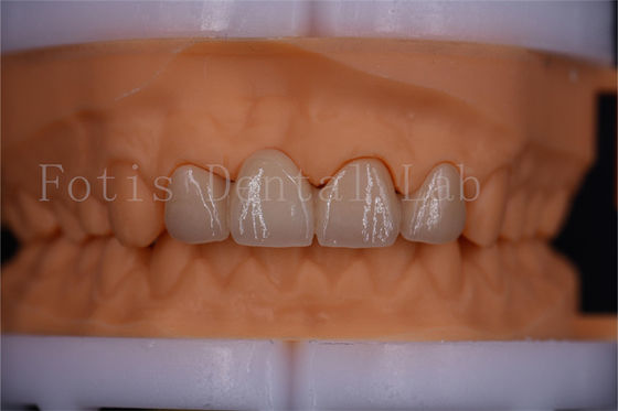 Corone digitali certificate FDA Dentrues di ponte Disegno Dimensioni personalizzabili