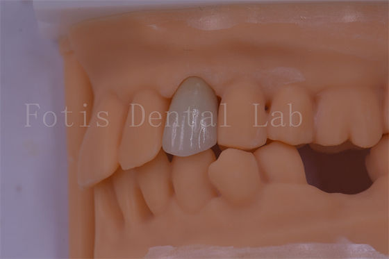 3 Forma/Exo Design Le corone dentali digitali sono più adatte e meno fastidiose