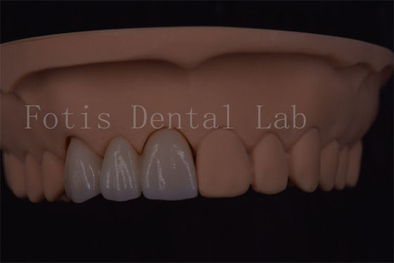 Corone dentali digitali certificate ISO per impianti dentali di varie dimensioni