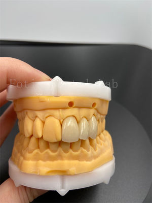 Corone digitali ad adattazione di precisione Impianto dentale con modalità di trasmissione di posta elettronica compatibile