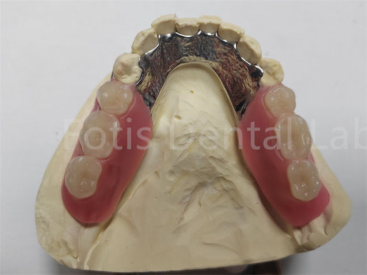 OEM Flessibile Denti parziali rimovibili facili da pulire / mantenere