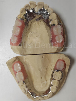 Personalizzazione Protesi parziali temporanee compatibili con i denti naturali