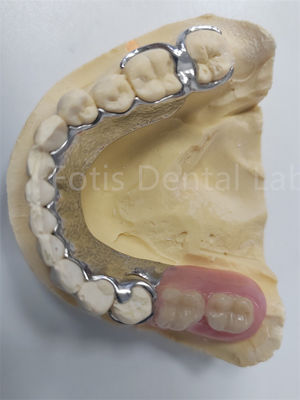 Sostituire denti mancanti Protesi dentale parziale rimovibile Progettazione flessibile