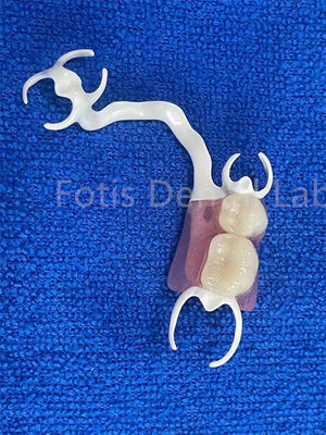 Protesi parziale rimovibile comodo e personalizzabile per la sostituzione di denti stabili
