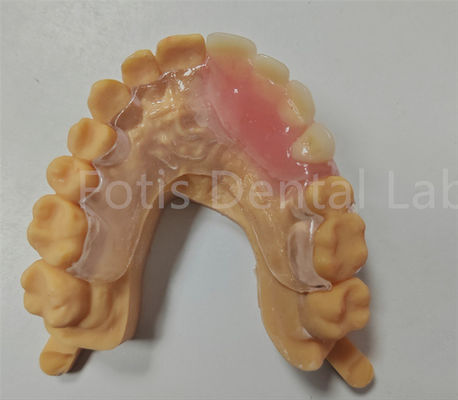 Dispositivo dentale TCS parziale con Valplast flessibile