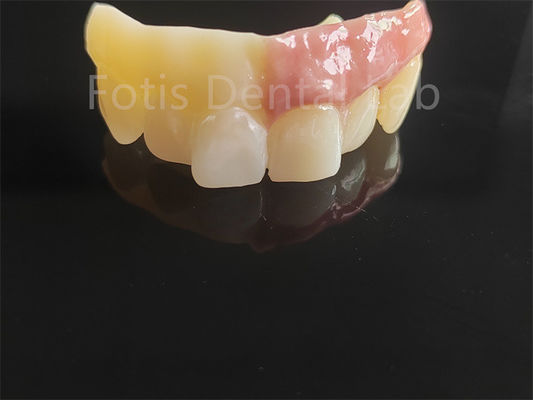 Monolitico zirconia stratificato con porcellana progettazione assistita da computer