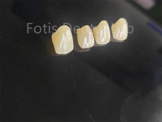 Circonia fusa di porcellana di qualità professionale per restauri dentali perfettamente adattati