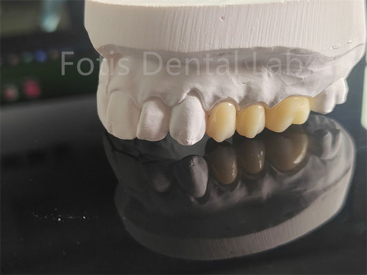 Circonia a strati di porcellana di alta resistenza per le corone dentali