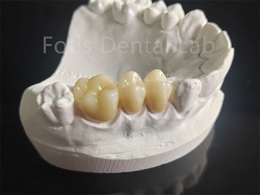 Circonia resistente all'usura stratificata con materiale dentale di porcellana