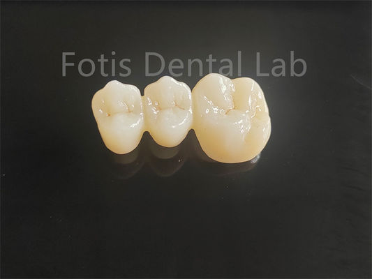 Circonia stratificata in porcellana ad alta resistenza per ponti dentali durevoli