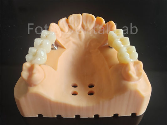Circonia a contorno completo stratificata con materiale dentale in porcellana