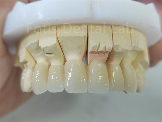 Prodotto dentale zirconia stratificata con porcellana facile manutenzione