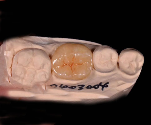 Infissi indiretti e di porcellana e infissi con sovrapposizioni dentali