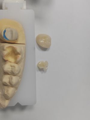Restaurazioni durevoli Infissi dentali Infissi superiori di resistenza e durata