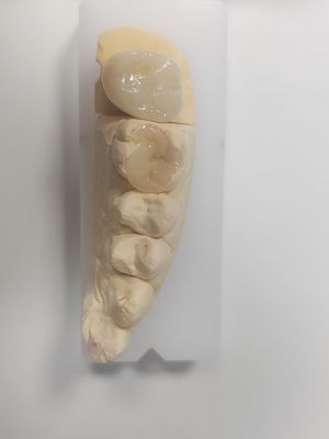 Infissi dentali per riempimento indiretto e ripristino del colore dei denti
