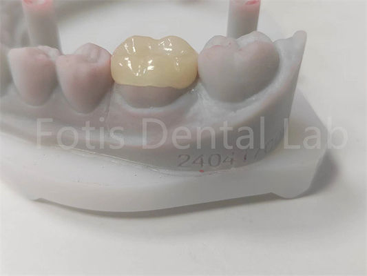 OEM Dental Inlay e Onlay Ceramic Restoration e Dental-colored Filling