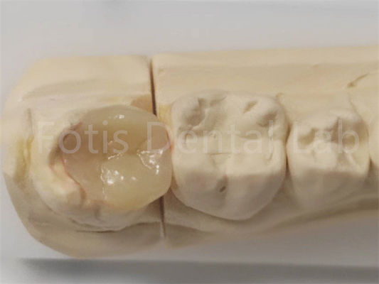 Infissi estetici e infissi in odontoiatria per riempimento indiretto e restauro dei denti