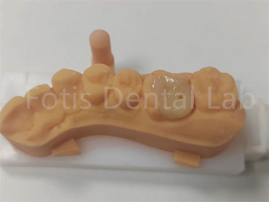 Restaurazioni dentali Infissi e rivestimenti in ceramica per una lunga durata
