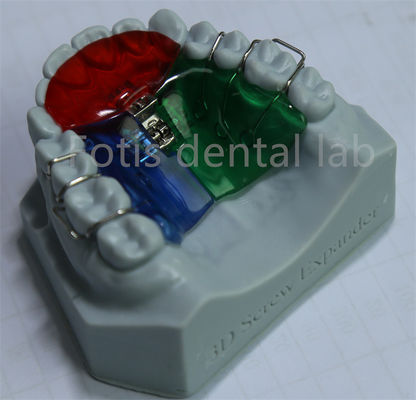 Espansivo ortodontico personalizzabile e regolabile per una ritenzione efficace dei denti