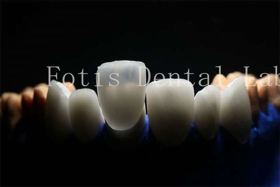 Finiture protesiche laminate durevoli e di lunga durata con materiale di porcellana