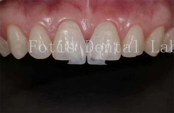 Carpetti laminati di laboratorio dentale ad alta traslucidità per la lucidatura naturale e la lucidatura