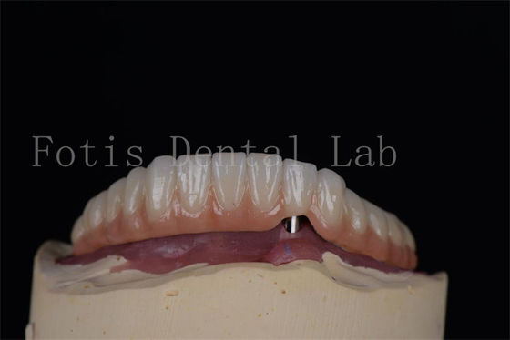 Impianti dentali in titanio o zirconia dall'aspetto naturale Procedura minimamente invasiva Facile da pulire