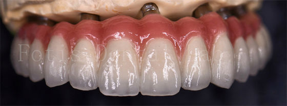 Corone di laboratorio dentali resistenti alle macchie per varie sostituzioni dentali