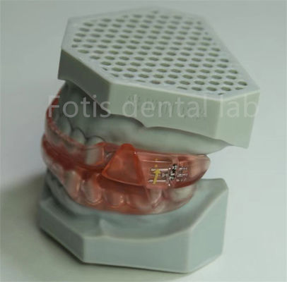 Laboratorio dentale Hyrax di costo accessibile Espansione ortodontica Ritenere facile da pulire e mantenere